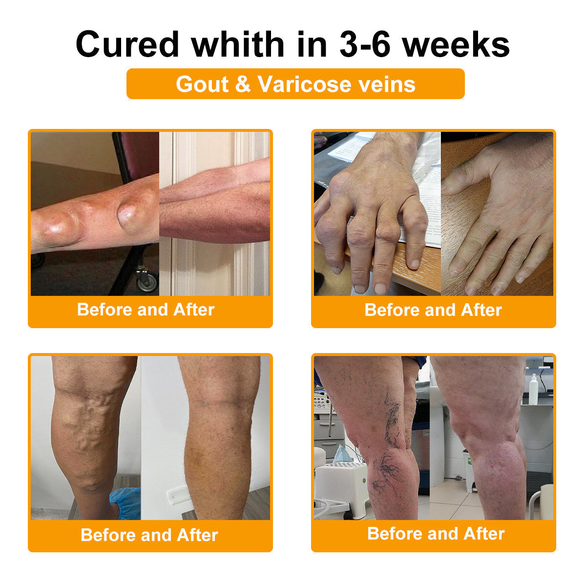 ⏰FLASH SALE: 59% OFF🔥HOOMWELL™ Botulinum Toxin & Bee Venom Pain-Relief Bone Healing Cream